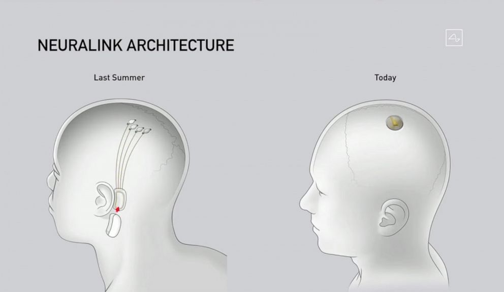 PHOTO: A illustration shows Neuralink disk implant at different stages of implantation during a livestream presentation on Aug. 28, 2020.