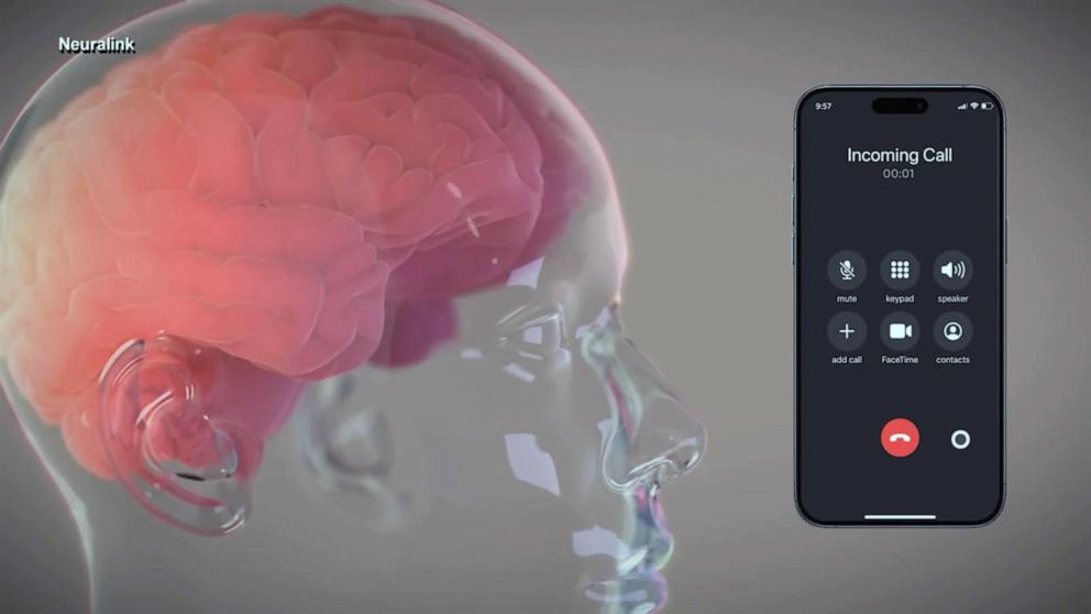 PHOTO: Neuralink says its devices can help people with debilitating conditions control external devices.