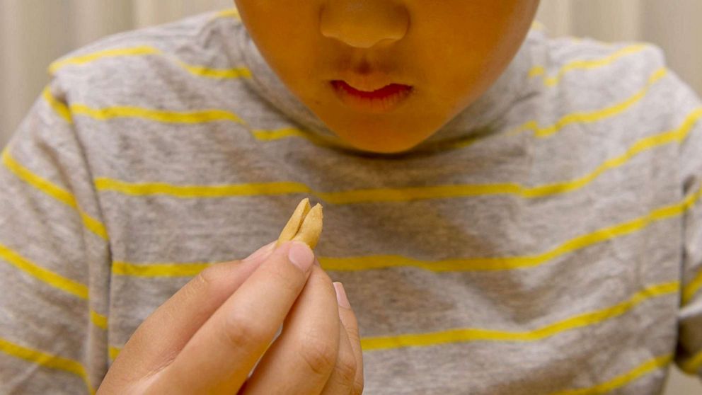 PHOTO:Michael Lee takes his peanut-allergy treatment: consuming a precisely measured dose of peanuts. The program began with a tiny amount of peanut powder mixed into liquids or soft foods in Sacramento, Calif., June 19, 2014.