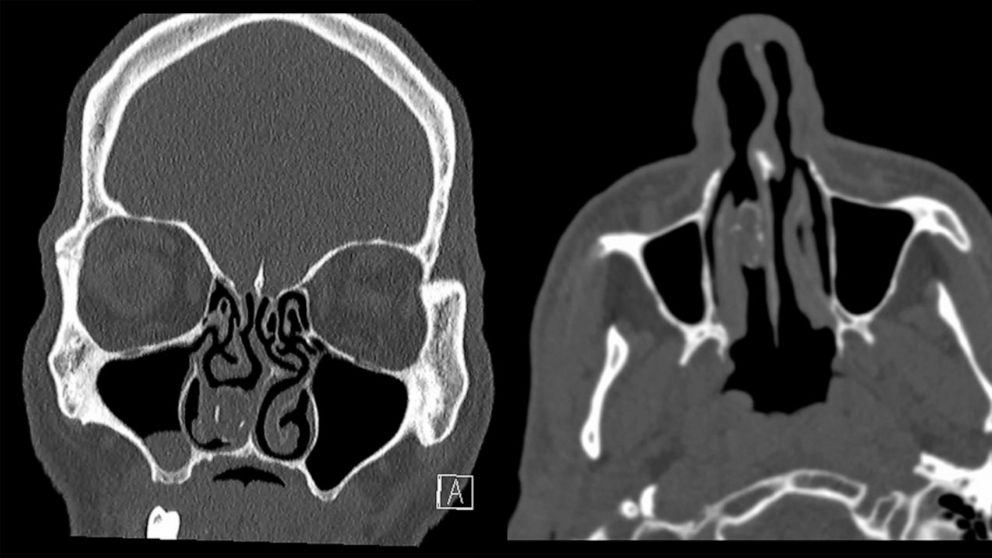 PHOTO: CT scan of a rhinolith in the patient's right nasal cavity.