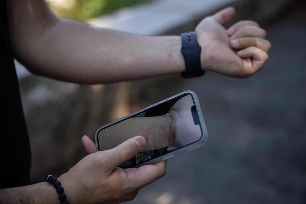 PHOTO: Kyle Planck, 26, who has recovered from monkeypox, shows scars from the rash on his skin, and a photo of the rash on his phone, in New York, July 19, 2022.