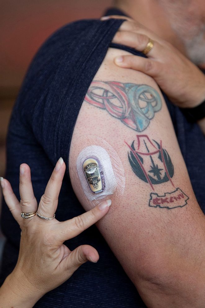 PHOTO: In their home in Whittier, Calif., Lisa Peralta pats Ric's Dexcom sensor to make sure it's staying on his arm. Before he got the device, Ric had to check his blood glucose via multiple finger pricks and plastic test strips every few hours.