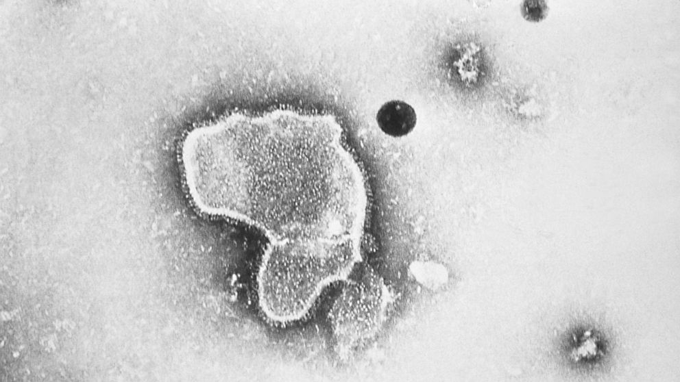 PHOTO: This 1981 photo provided by the Centers for Disease Control and Prevention (CDC) shows an electron micrograph of Respiratory Syncytial Virus, also known as RSV.