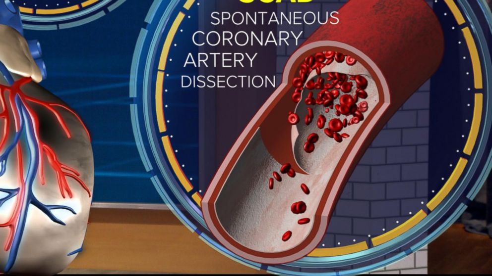 PHOTO: ABC News' chief medical correspondent Dr. Jennifer Ashton uses a 3-D augmented reality human model to demonstrate what a traditional heart attack caused by a Spontaneous Coronary Artery Dissection (SCAD) looks like.