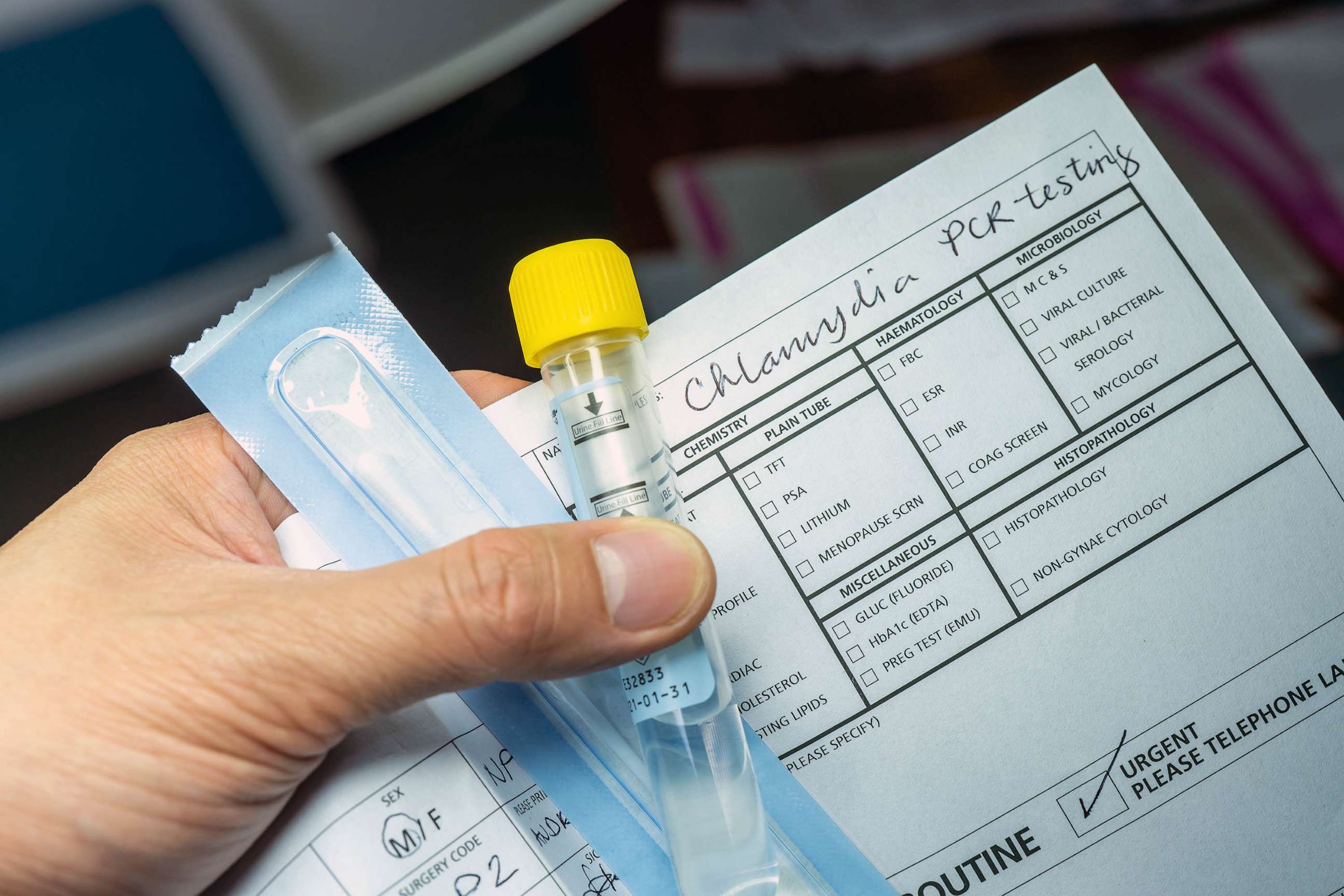 STOCK PHOTO: A sample collection tube for chlamydia PCR testing which is commonly used in the laboratory to screen patients for chlamydia infection.