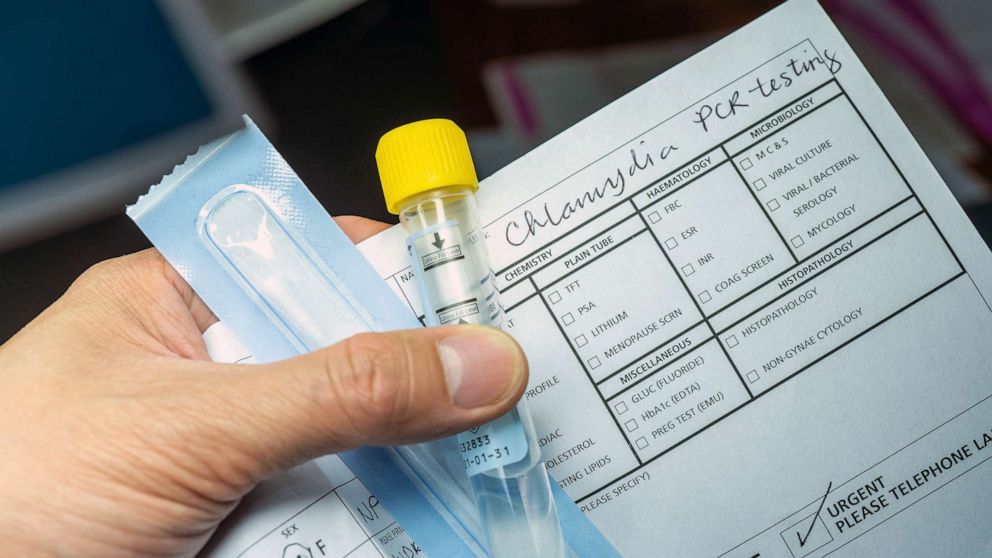 STOCK PHOTO: A sample collection tube for chlamydia PCR testing which is commonly used in the laboratory to screen patients for chlamydia infection.