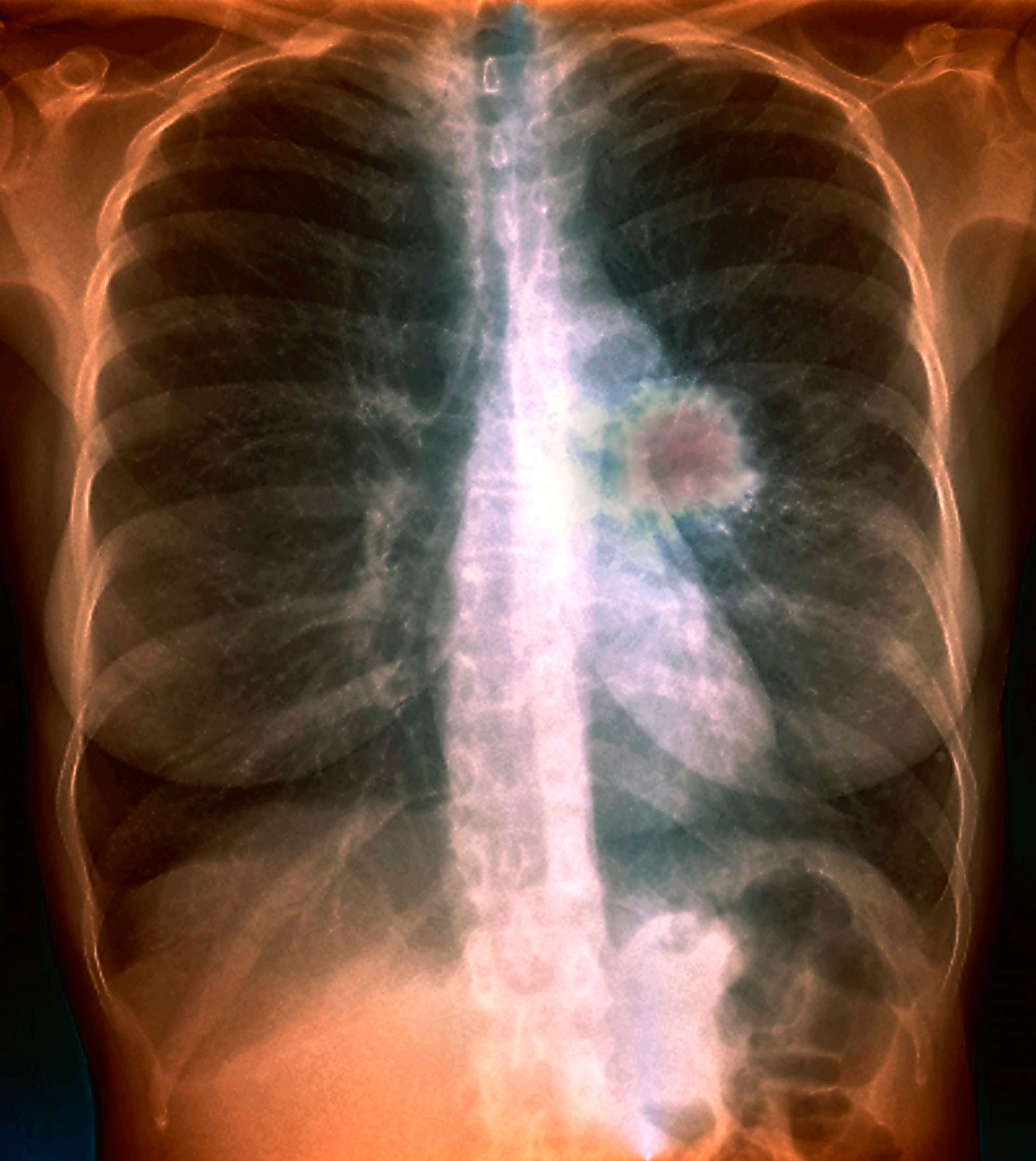 PHOTO: An x-ray showing lung cancer.