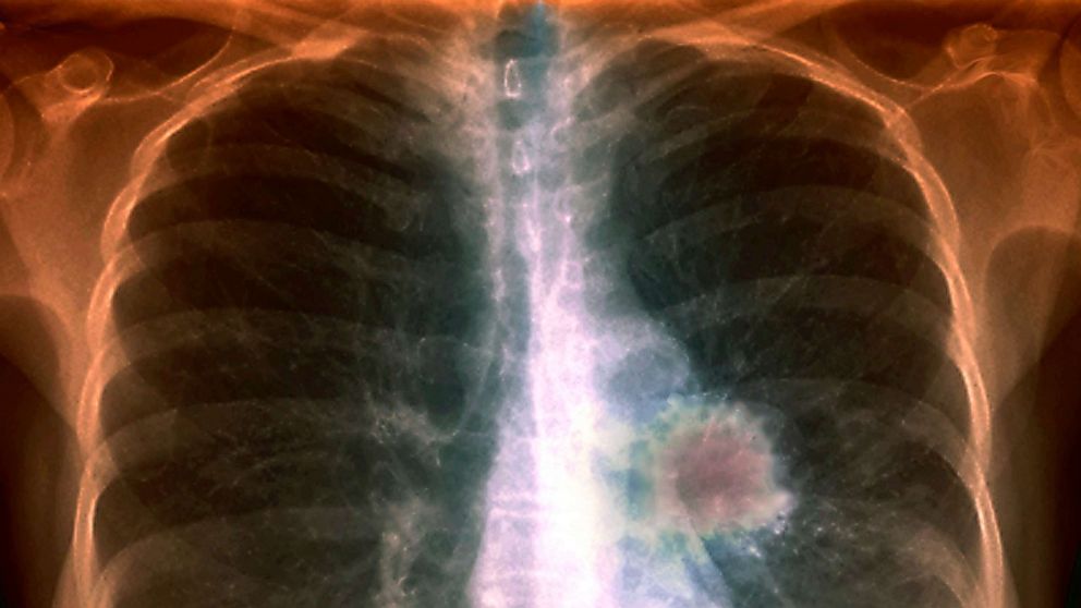 PHOTO: An x-ray showing lung cancer.