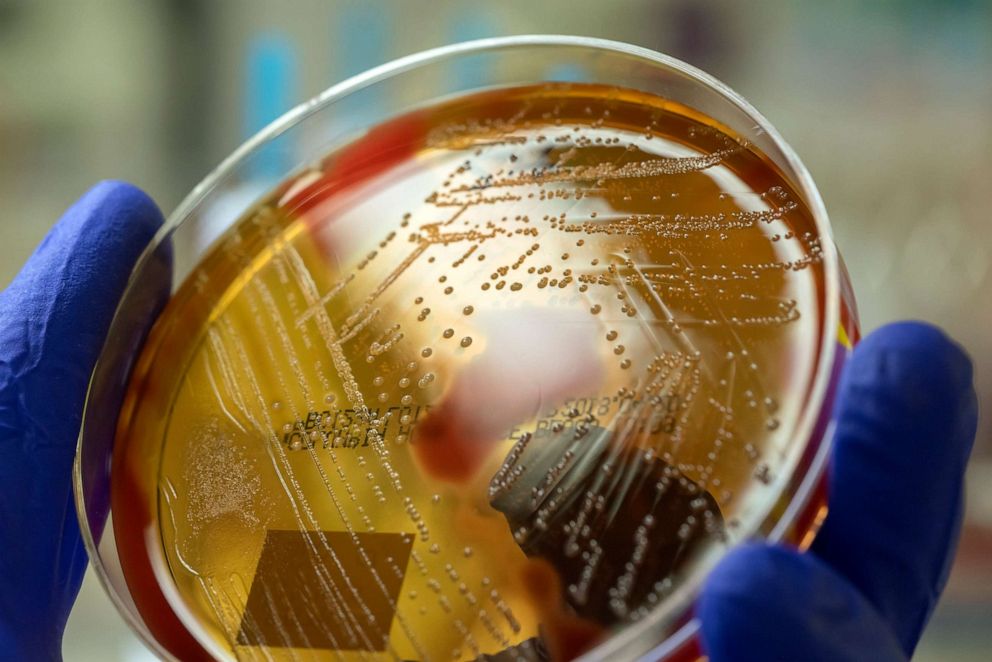 PHOTO: A microbiologist holding a blood agar plate showing the beta-hemolysis caused by pathogenic bacteria Streptococcus pyogenes.