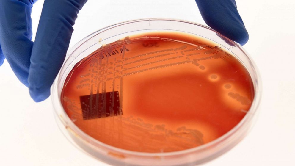 PHOTO: Jean Lee, a PhD student at Melbourne's Doherty Institute, displays the superbug Staphylcocus epidermidis on an agar plate in Melbourne, Sept. 4, 2018.