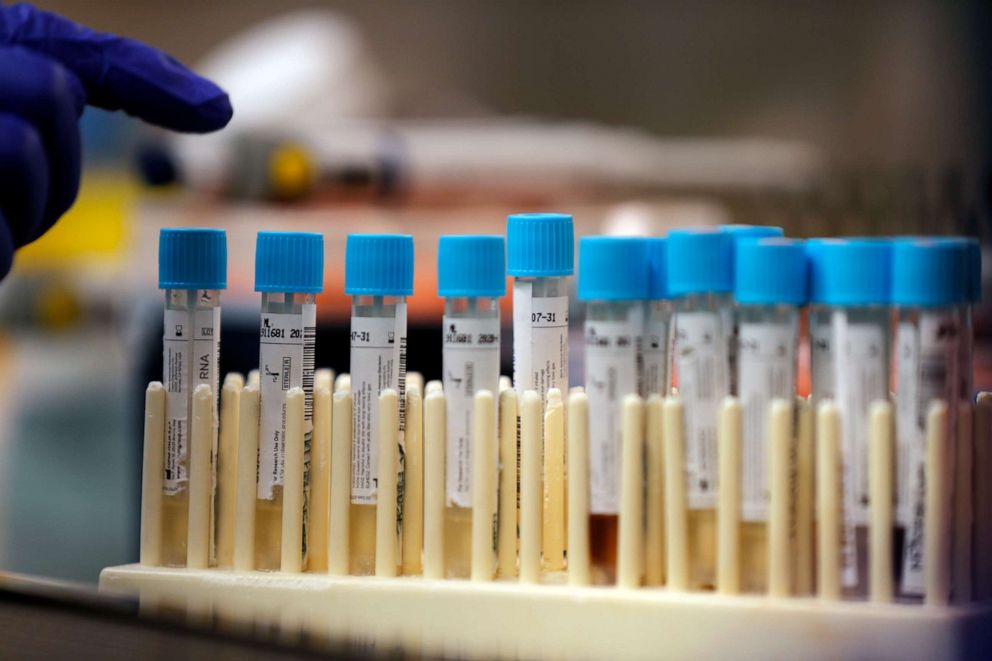 PHOTO: Vials with samples taken for the new coronavirus are counted before they are prepared for RNA testing at the molecular pathology lab at Tulane University School of Medicine in New Orleans, April 2, 2020. 