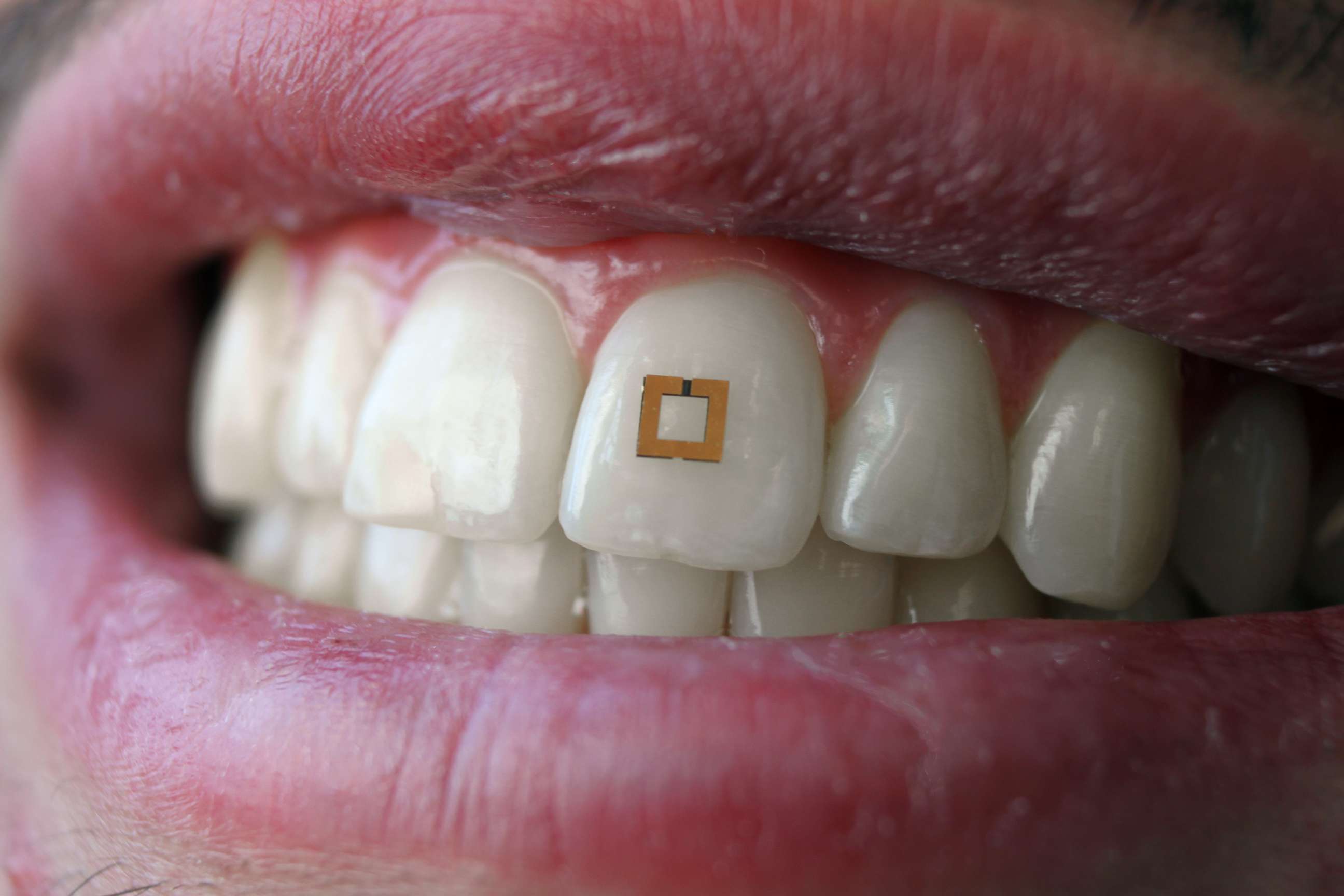 PHOTO: Researchers at Tufts University are experimenting with sensors attached to human teeth that might be able to monitor food and caloric intake and send signals to nearby devices.