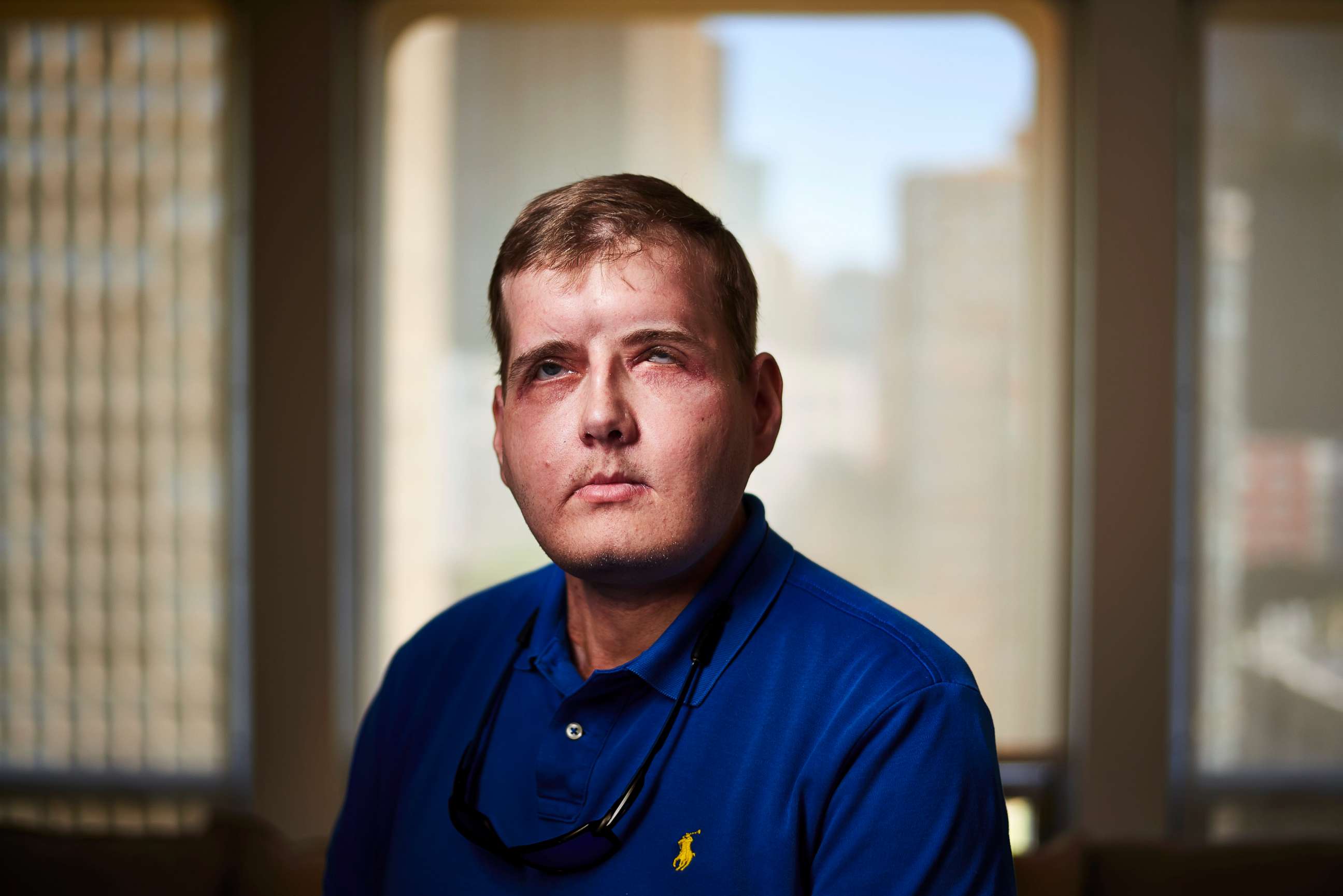 Patrick Hardison Picture Groundbreaking facial transplants ABC News