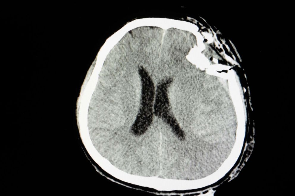 PHOTO: CT skull film of a patient with traumatic brain injury is pictured in this undated stock photo.