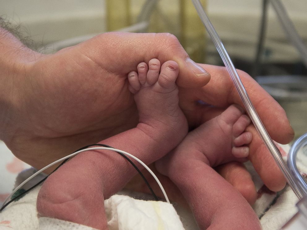 PHOTO: The first American baby born from a transplanted uterus is photographed here after being born at the Baylor University Medical Center in Dallas, Texas. 