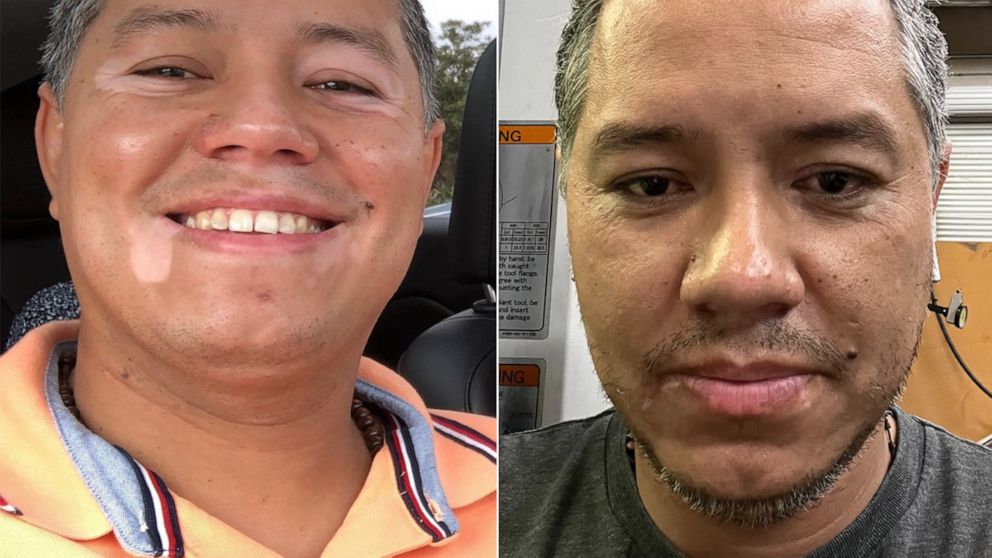 PHOTO: Berardo Rivas before and after using the first topical JAK inhibitor cream for the treatment of vitiligo.