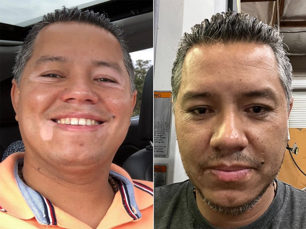 PHOTO: Berardo Rivas before and after using the first topical JAK inhibitor cream for the treatment of vitiligo.