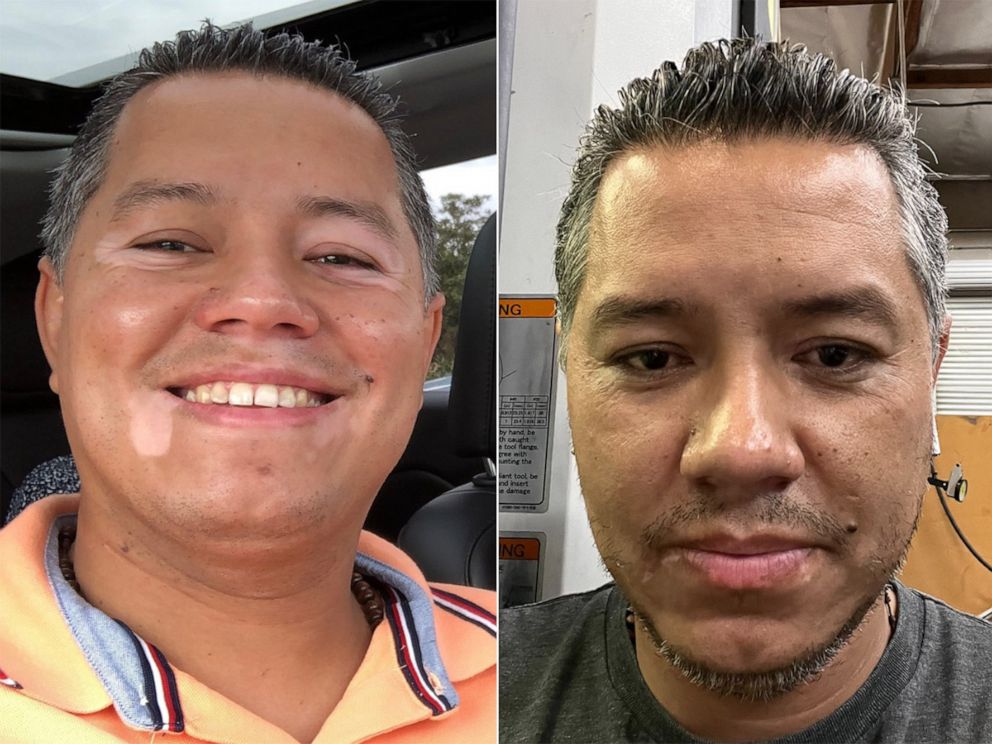 semaglutide skin discoloration Headlines from ABC News Live