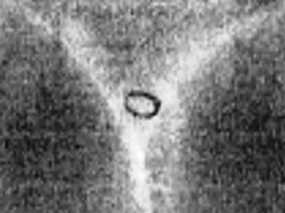 PHOTO: An Ohio jail noticed that an alleged thief had swallowed a ring thanks to a new kind of x-ray.