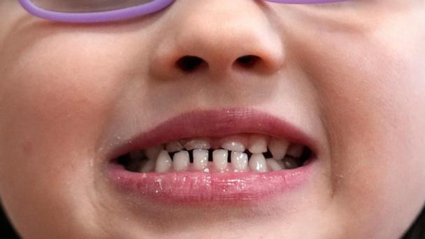 FILE - A child shows off her teeth after a dental exam in Concord, N.H., Wednesday, Feb. 21, 2024. (AP Photo/Robert F. Bukaty, file)