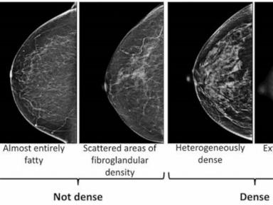 Dense breasts can make it harder to spot cancer on a mammogram