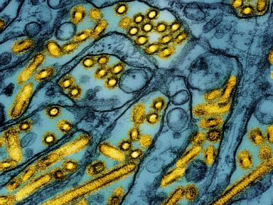 Health officials say Louisiana patient is first severe bird flu case in US