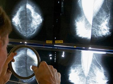 Why Mammogram Guidelines Are So Confusing and How to Decide What You Actually Need