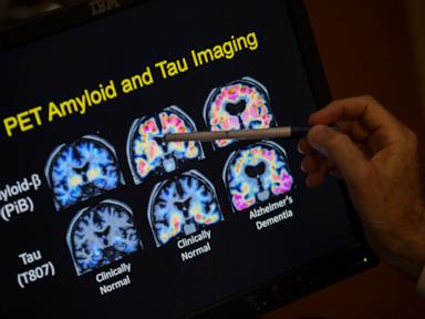 Want to lower your risk of dementia? It doesn't involve a blood test