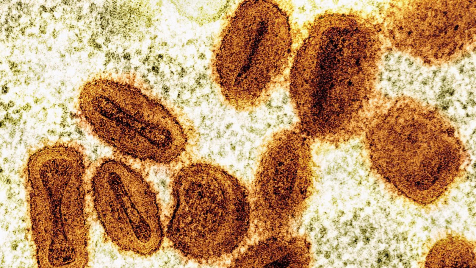 US health officials report 1st case of new form of mpox in a traveler