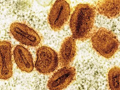 US health officials report 1st case of new form of mpox in a traveler