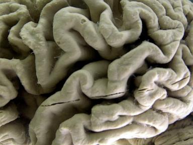 Study shows blood test can help identify people at high risk for Alzheimer's disease