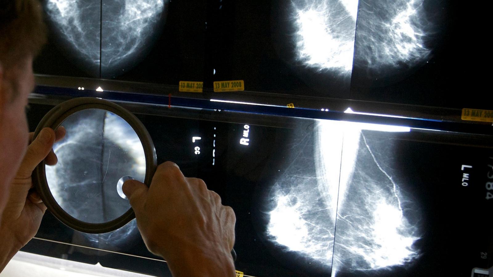 Some breast cancer patients can avoid certain surgeries, studies suggest