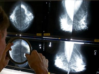 Some breast cancer patients can avoid certain surgeries, studies suggest