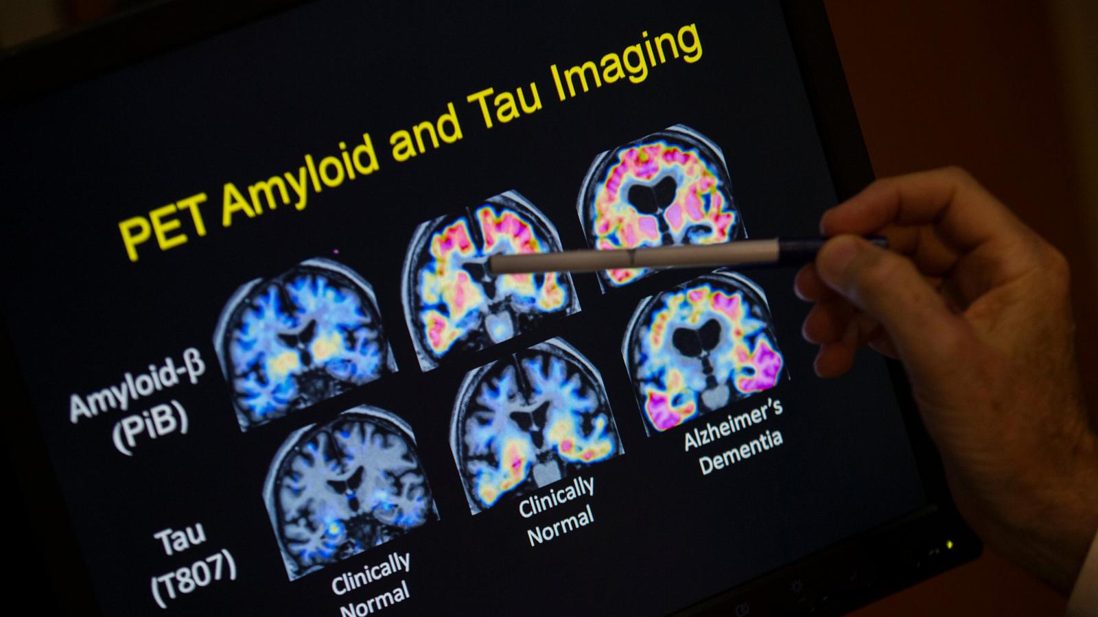 FDA OKs first blood test that can help diagnose Alzheimer’s disease