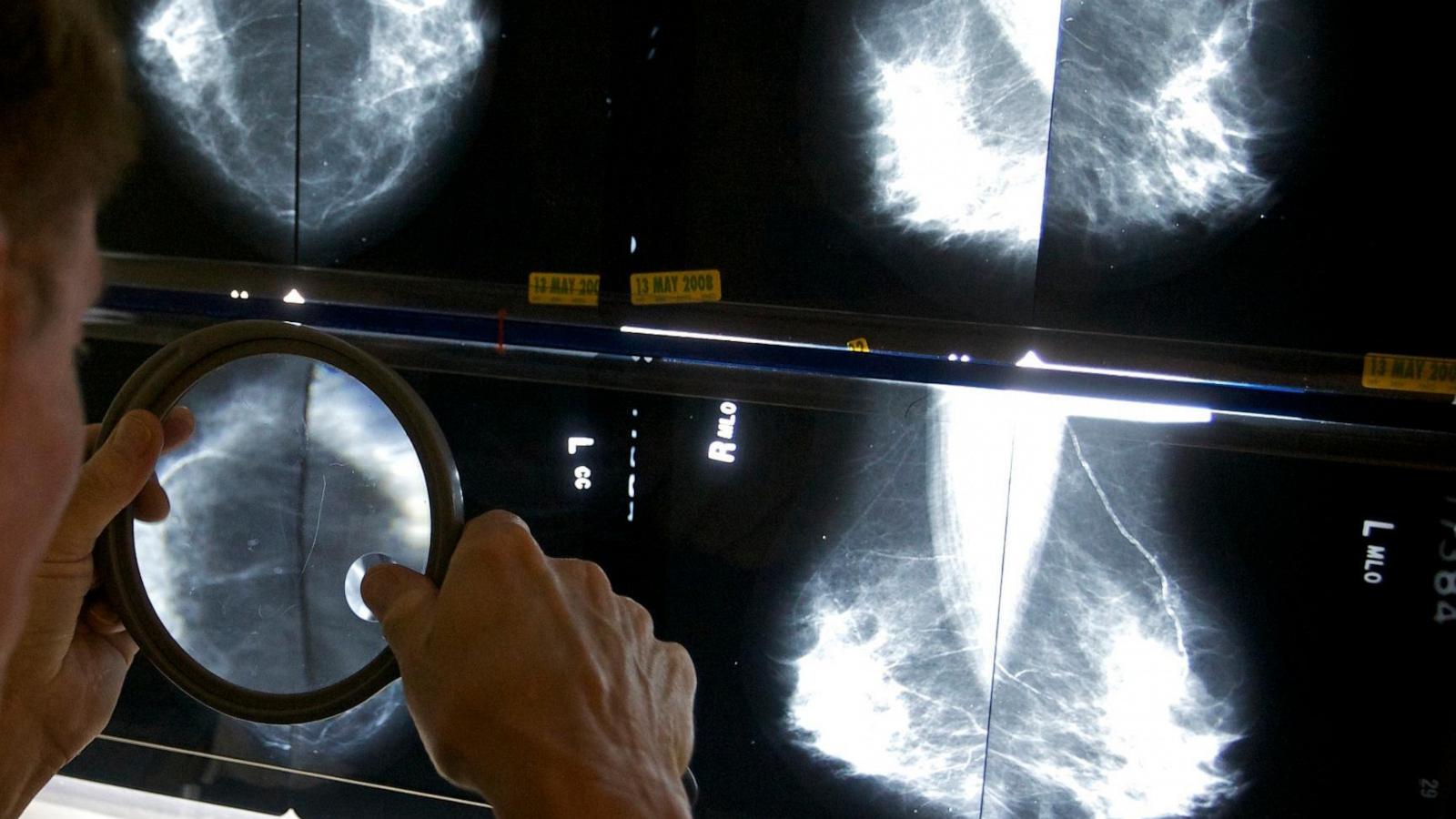Cancer before age 50 is increasing. A new study looks at which types