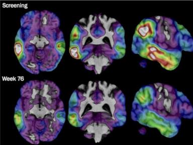 Experimental Alzheimer's drug shows some promise as researchers hunt new approaches