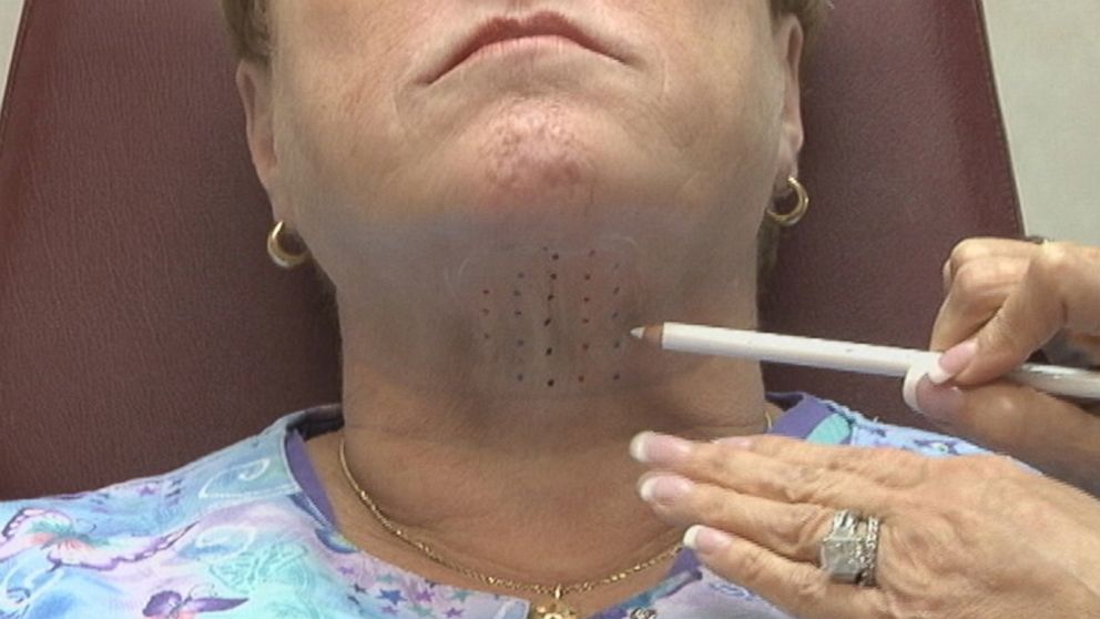 PHOTO: FDA approves a new drug injection that could remove the double-chin.