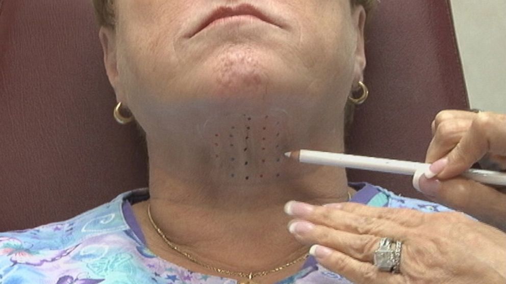 PHOTO: FDA approves a new drug injection that could remove the double-chin.