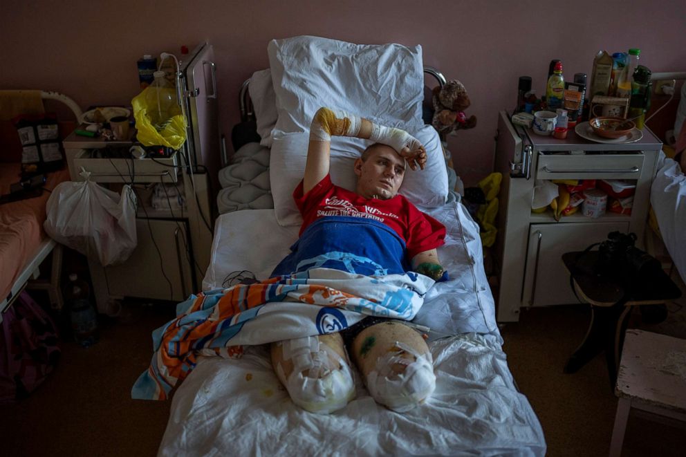 PHOTO: Anton Gladun, 22, lies on his bed at the hospital in Cherkasy, Ukraine, May 6, 2022. A military medic, Gladun lost both legs and the left arm due to a mine explosion on March 27.
