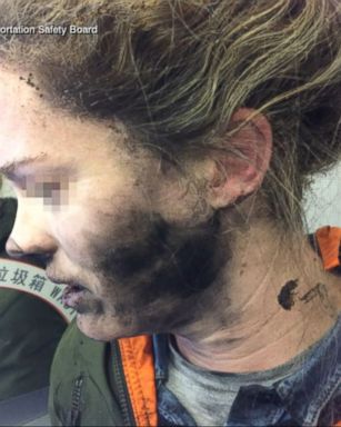 VIDEO: The female passenger, on a flight from Beijing to Melbourne, suffered a blackened face and blisters on her hands.