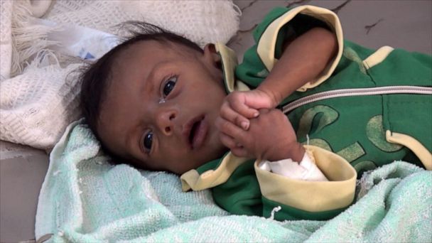 Video Yemen On The Brink Of Starvation - ABC News