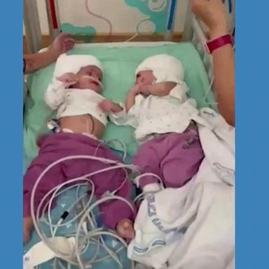 PHOTO: One-year-old Israeli twin girls, who were born conjoined at the back of their heads, can make eye contact for the first time after undergoing a rare separation surgery.