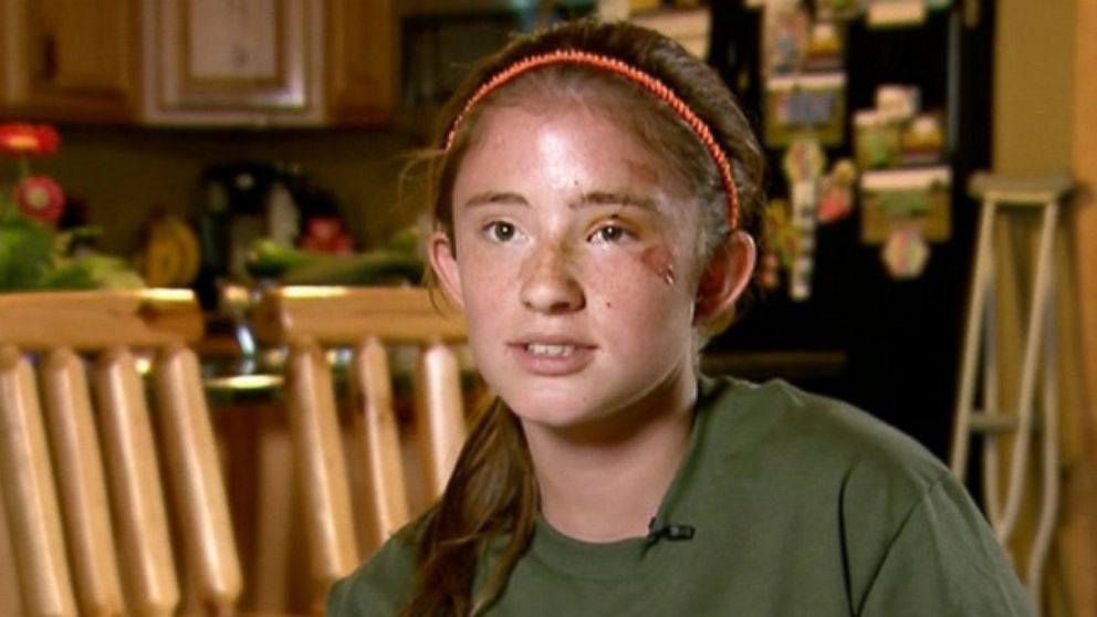 12YearOld Girl Thought She Was A Goner In Bear Attack ABC News