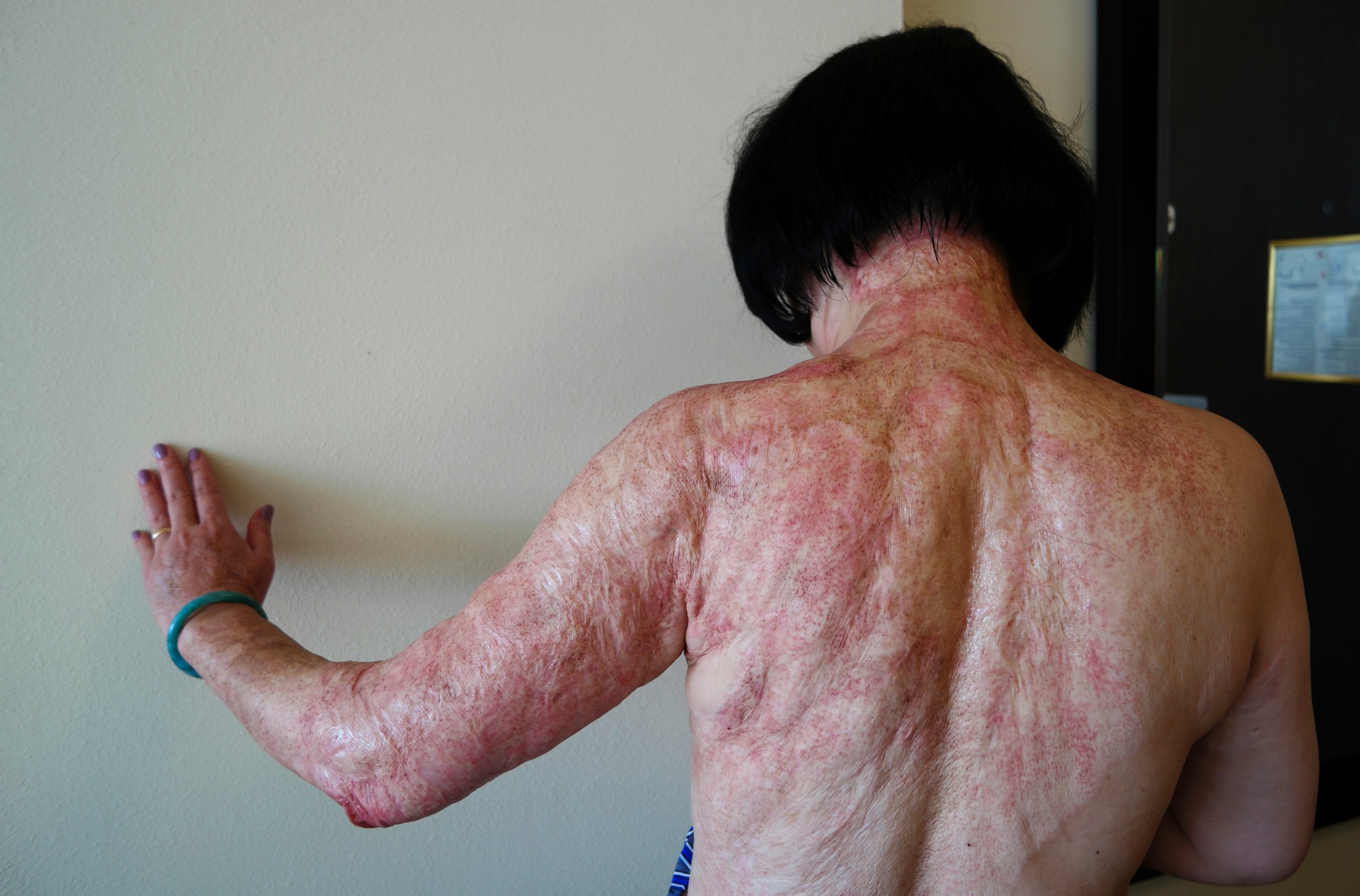 PHOTO: In this Sept. 27, 2015 photo, Kim Phuc shows the burn scars on her back and arms after laser treatments in Miami that caused by a napalm bomb in Vietnam more than 40 years ago. 