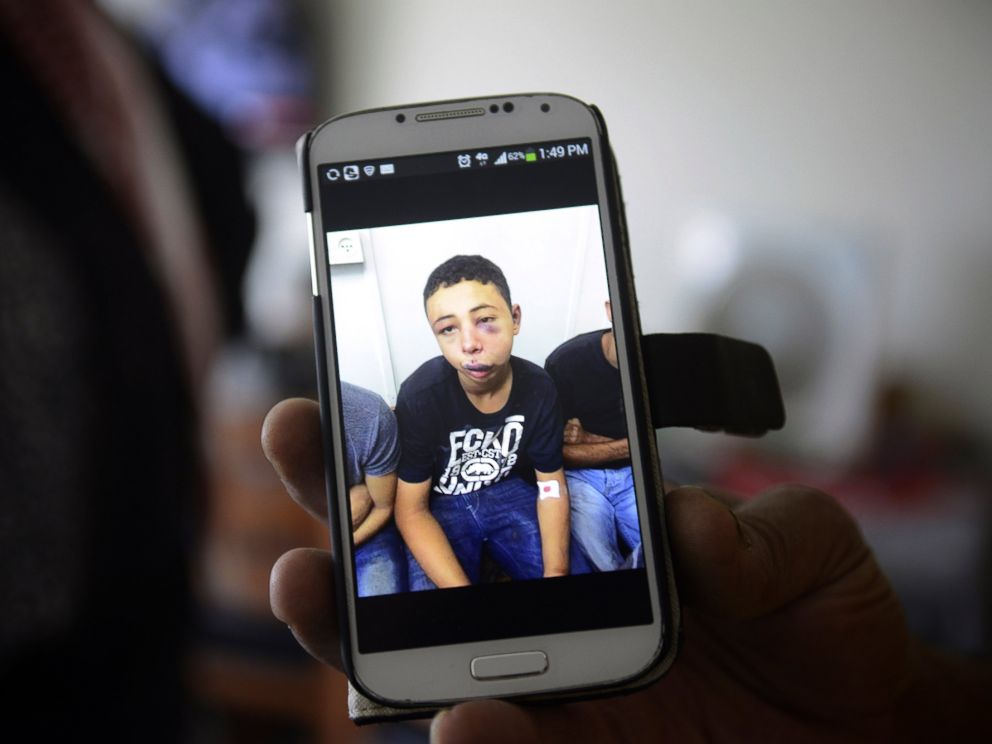 PHOTO: Suha Abu Khdeir shows a mobile phone photo of her son Tariq Abu Khdeir, taken in a hospital after he was beaten and arrested by the Israeli police during clashes Thursday, in Jerusalem, Saturday, July 5, 2014.