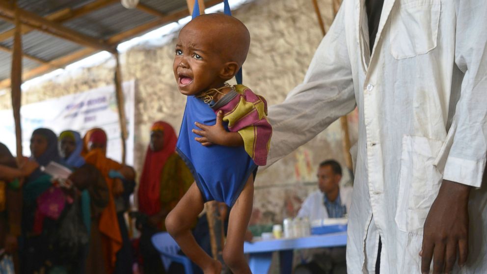 PHOTO: A malnourished child is processed by an aid worker for a UNICEF, funded health program catering to children displaced by drought, at a facility in Baidoa town, the capital of Bay region of south-western Somalia, on March 15, 2017.