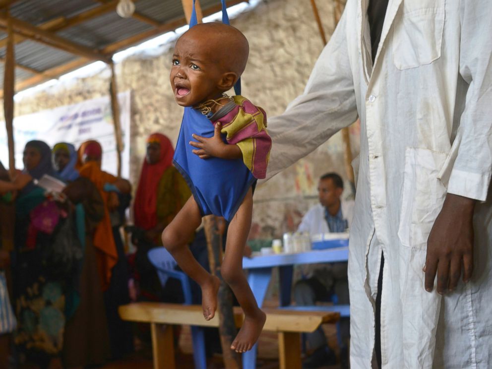 PHOTO: A malnourished child is processed by an aid worker for a UNICEF, funded health program catering to children displaced by drought, at a facility in Baidoa town, the capital of Bay region of south-western Somalia, on March 15, 2017.
