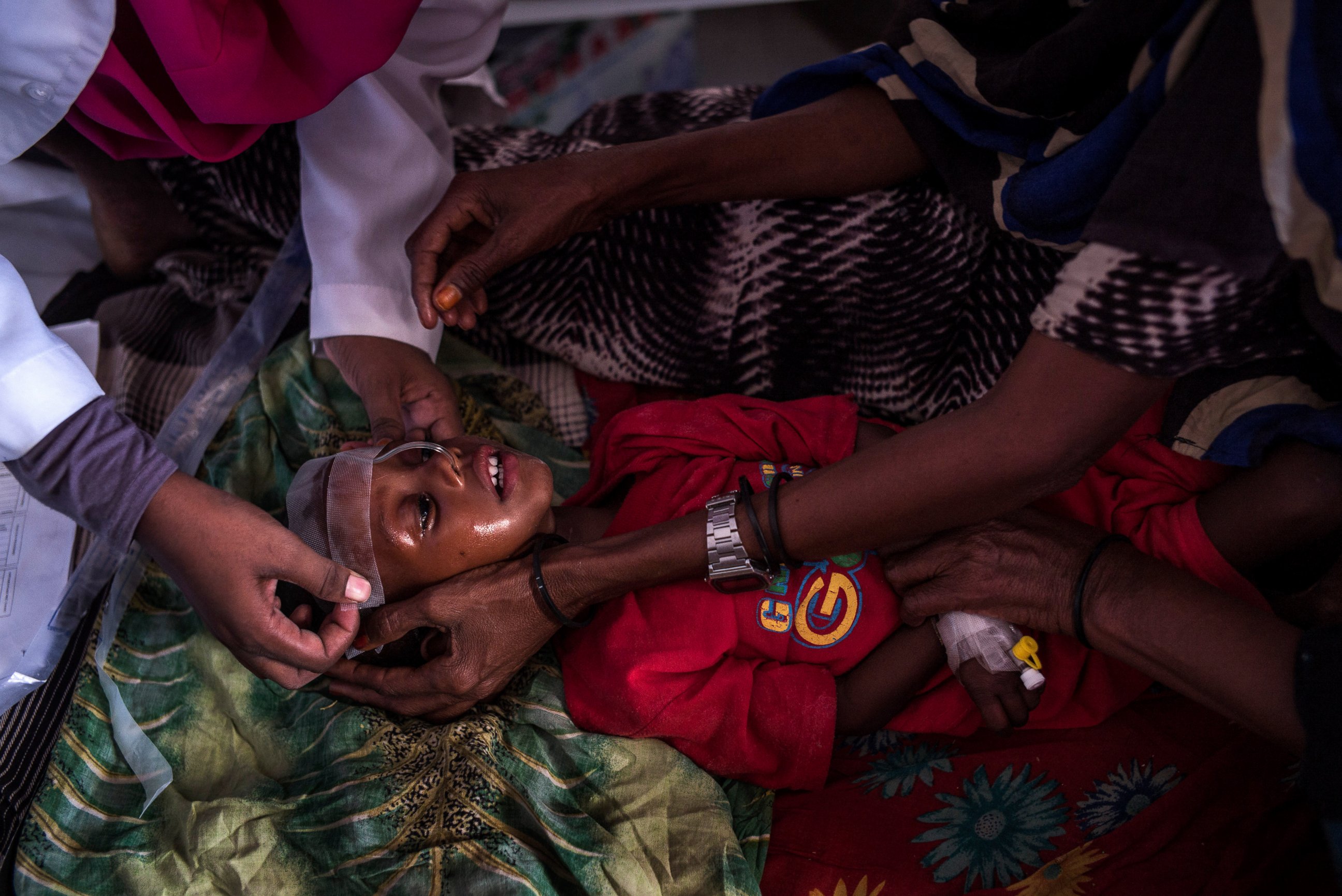 PHOTO: Medical staff treat a child suffering from malnutrition at Garowe General Hospital, Feb. 27, 2017, in Garowe, Somalia.