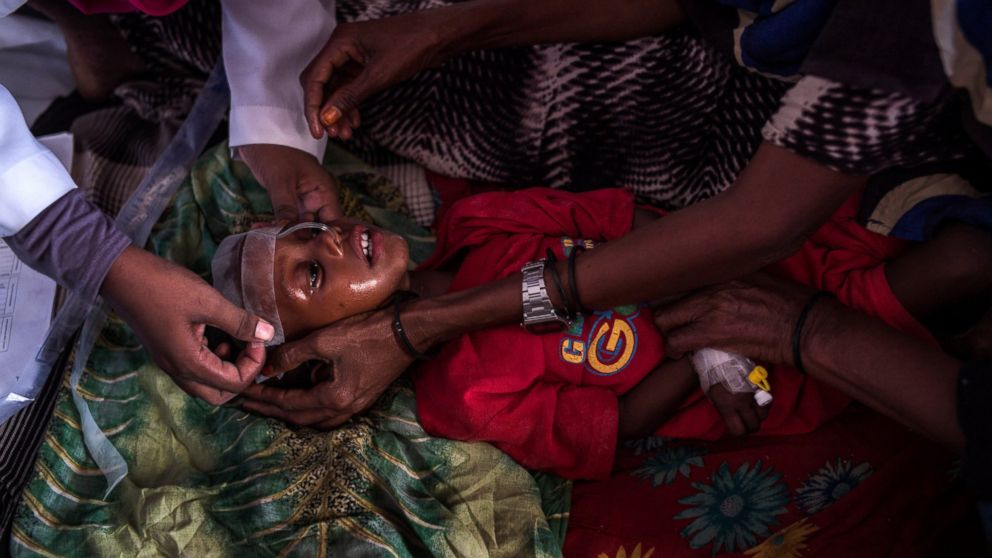 PHOTO: Medical staff treat a child suffering from malnutrition at Garowe General Hospital, Feb. 27, 2017, in Garowe, Somalia.