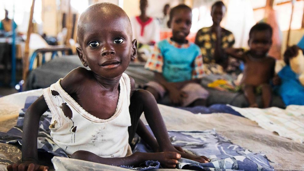 Aleo Tong, 1, who suffers severe malnutrition, rests on a bed at the MSF Nutrition Center in Aweil Hospital, Aug. 2, 2016.